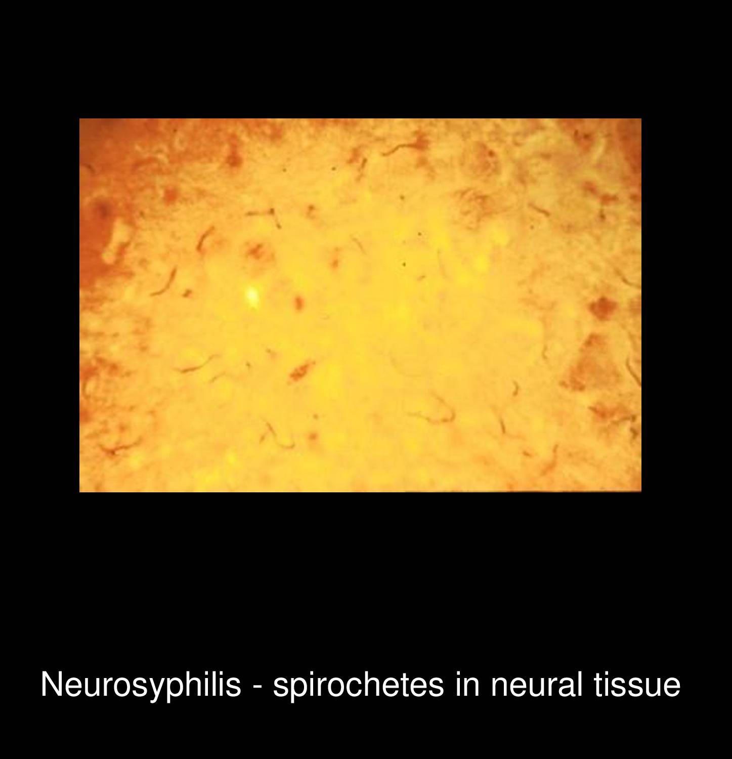 Syphilitic onychia and paronychia showing nail plate dystrophy and periungual inflammation caused by Treponema pallidum infection